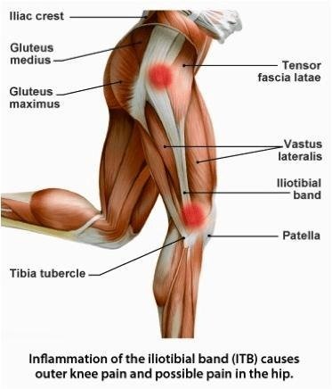 image 4 Iliotibial Band Syndrome (ITB Syndrome)